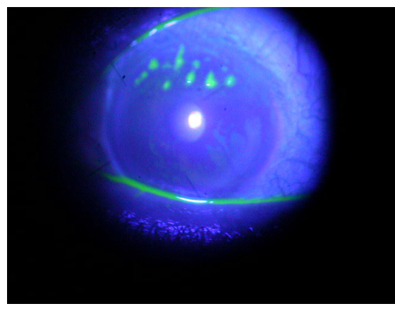 結膜炎,過敏性結膜炎,結膜炎治療,珠海希瑪眼科醫院