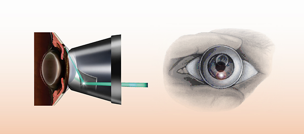 青光眼,青光眼治療,治療青光眼醫(yī)院,珠海希瑪眼科醫(yī)院
