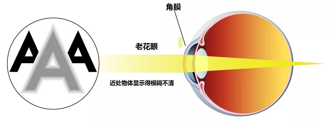 老花眼,老花眼鏡,老花眼治療,珠海希瑪眼科醫院 老花眼,老花眼鏡,老花眼治療,珠海希瑪眼科醫院