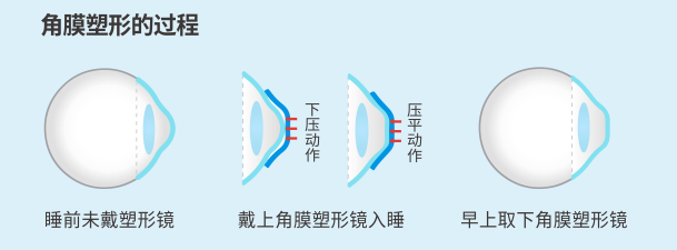 OK鏡,珠海OK鏡,珠海希瑪眼科醫院 OK鏡,珠海OK鏡,珠海希瑪眼科醫院