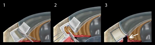 青光眼,青光眼治療,青光眼癥狀,珠海希瑪眼科醫(yī)院 青光眼,青光眼治療,青光眼癥狀,珠海希瑪眼科醫(yī)院