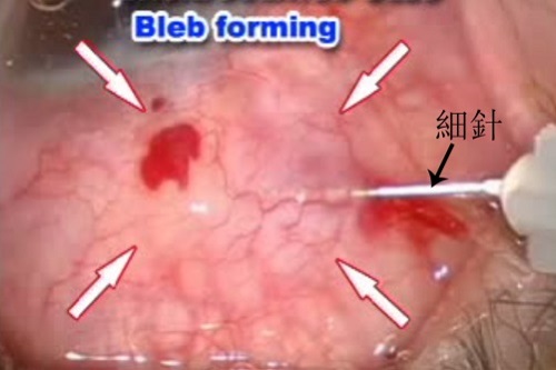 青光眼,青光眼治療,青光眼癥狀,珠海希瑪眼科醫(yī)院 青光眼,青光眼治療,青光眼癥狀,珠海希瑪眼科醫(yī)院