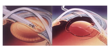 白內障,白內障手術,珠海希瑪眼科