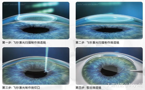 近視,近視手術,術前檢查,珠海?，斞劭漆t院
