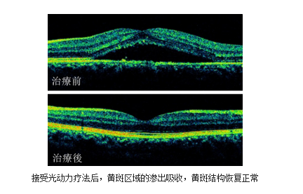 昆明哪家眼科能治視網膜脫落