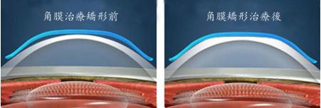 OK鏡,珠海OK鏡,珠海希瑪林順潮眼科醫院 OK鏡,珠海OK鏡,珠海希瑪林順潮眼科醫院