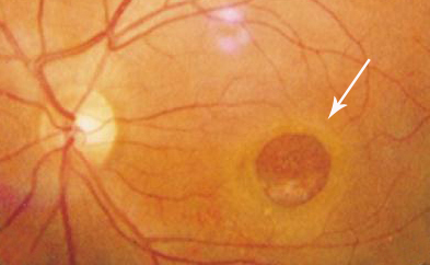 黃斑,黃斑裂孔,珠海治療黃斑的醫院,珠海希瑪林順潮眼科醫院