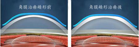 OK鏡,角膜,角膜塑形鏡,珠海希瑪眼科醫(yī)院 OK鏡,角膜,角膜塑形鏡,珠海希瑪眼科醫(yī)院