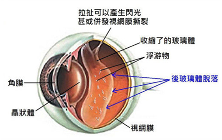 飛蚊癥,珠海飛蚊癥怎么治療,珠海希瑪林順潮眼科醫院 飛蚊癥,珠海飛蚊癥怎么治療,珠海希瑪林順潮眼科醫院