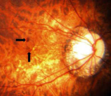 珠海高度近視,珠海近視醫院,珠海希瑪林順潮眼科醫院 珠海高度近視,珠海近視醫院,珠海希瑪林順潮眼科醫院