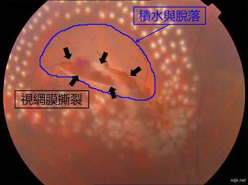 希瑪眼科醫院：視網膜脫落更愛找上這幾類人