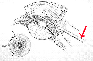 青光眼,先天性青光眼,青光眼治療,珠海希瑪林順潮眼科醫(yī)院 青光眼,先天性青光眼,青光眼治療,珠海希瑪林順潮眼科醫(yī)院