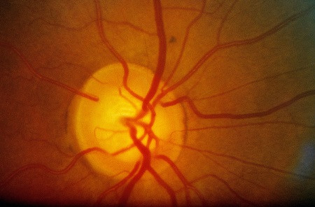 青光眼,先天性青光眼,青光眼治療,珠海希瑪林順潮眼科醫(yī)院 青光眼,先天性青光眼,青光眼治療,珠海希瑪林順潮眼科醫(yī)院