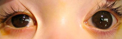 青光眼,先天性青光眼,青光眼治療,珠海希瑪林順潮眼科醫(yī)院 青光眼,先天性青光眼,青光眼治療,珠海希瑪林順潮眼科醫(yī)院