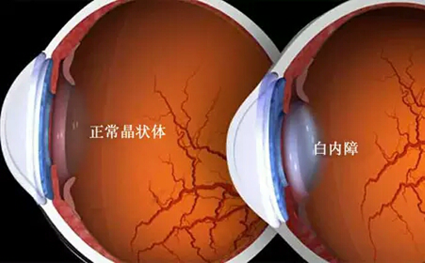 黃斑病變,珠海黃斑治療醫院,珠海希瑪林順潮眼科醫院 黃斑病變,珠海黃斑治療醫院,珠海希瑪林順潮眼科醫院