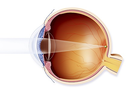 白內(nèi)障怎么治療
