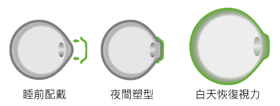 OK鏡,珠海OK鏡,珠海希瑪林順潮眼科醫院 OK鏡,珠海OK鏡,珠海希瑪林順潮眼科醫院