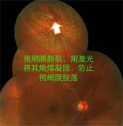 飛蚊癥,珠海治療飛蚊癥,珠海希瑪眼科醫院