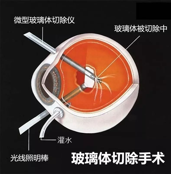 視網(wǎng)膜脫落,珠海視網(wǎng)膜脫落怎么辦,視網(wǎng)膜脫落治療醫(yī)院 視網(wǎng)膜脫落,珠海視網(wǎng)膜脫落怎么辦,視網(wǎng)膜脫落治療醫(yī)院