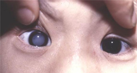 兒童白內障有哪些癥狀？