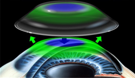 OK鏡,珠海OK鏡哪家好,珠海希瑪林順潮眼科醫院 OK鏡,珠海OK鏡哪家好,珠海希瑪林順潮眼科醫院