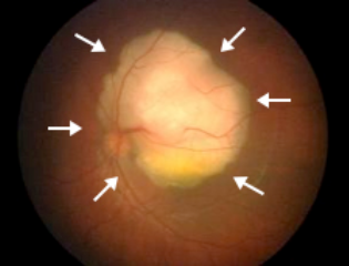 視網膜癌癥,視網膜母細胞瘤治療,珠海希瑪林順潮眼科醫院