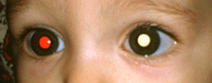 視網膜癌癥,視網膜母細胞瘤治療,珠海希瑪林順潮眼科醫院