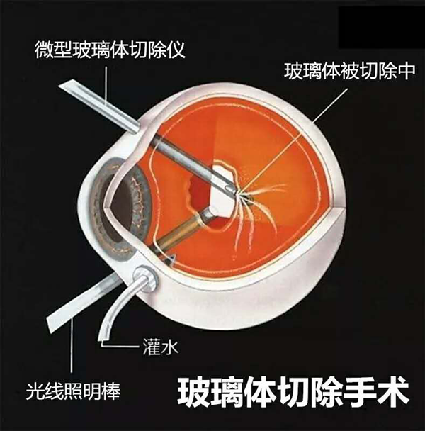 視網膜脫落,珠海視網膜脫落怎么辦,視網膜脫落治療醫院