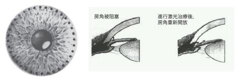 珠海青光眼哪家好,珠海青光眼好的醫院,珠海青光眼治療辦法 珠海青光眼哪家好,珠海青光眼好的醫院,珠海青光眼治療辦法