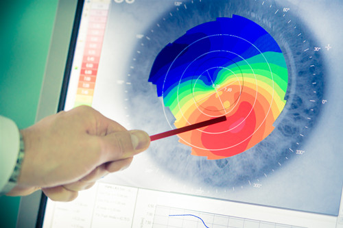圓錐角膜,圓錐角膜怎么辦,珠海圓錐角膜治療醫院