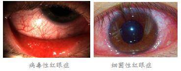 眼睛紅、痛是什么原因造成？