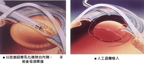 白內障和老花眼有什么區別 白內障和老花眼有什么區別