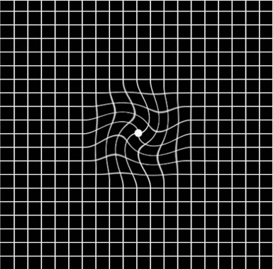 眼睛里面有黃斑怎么辦,黃斑變性怎治療,治療黃斑的醫院