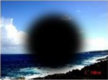 眼睛里面有黃斑怎么辦,黃斑變性怎治療,治療黃斑的醫院