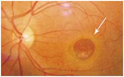 視網膜裂孔如何預防,視網膜裂孔怎么辦,怎么治療視網膜裂孔,治療視網膜裂孔的辦法 視網膜裂孔如何預防,視網膜裂孔怎么辦,怎么治療視網膜裂孔,治療視網膜裂孔的辦法