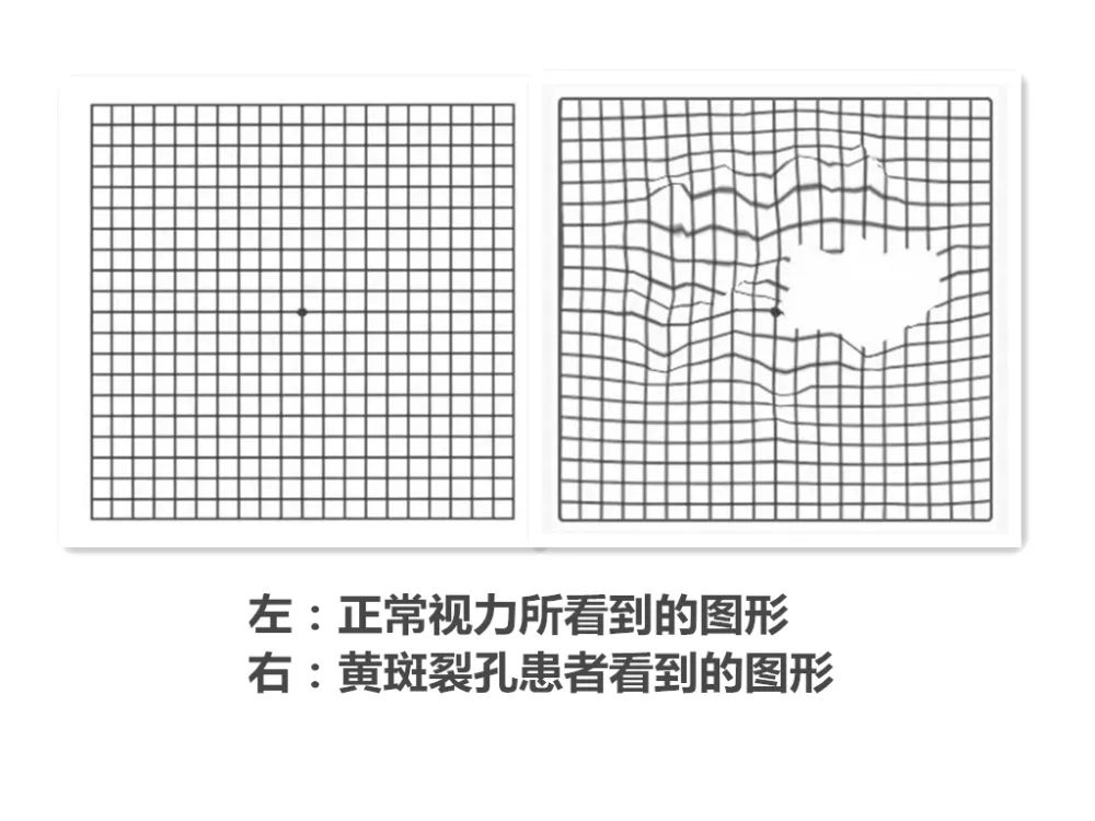 視網膜裂孔如何預防,視網膜裂孔怎么辦,怎么治療視網膜裂孔,治療視網膜裂孔的辦法 視網膜裂孔如何預防,視網膜裂孔怎么辦,怎么治療視網膜裂孔,治療視網膜裂孔的辦法