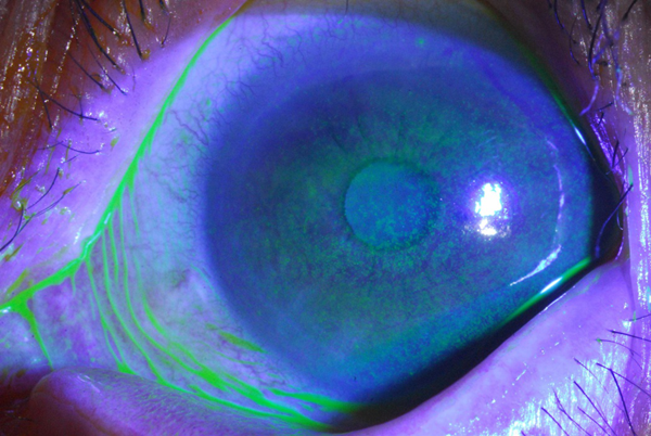 青光眼的治療方法,怎么預防青光眼,珠海治療青光眼的地方 青光眼的治療方法,怎么預防青光眼,珠海治療青光眼的地方