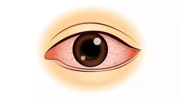 角膜炎怎么治療,治療角膜炎的辦法,珠海哪里可以看角膜炎 角膜炎怎么治療,治療角膜炎的辦法,珠海哪里可以看角膜炎