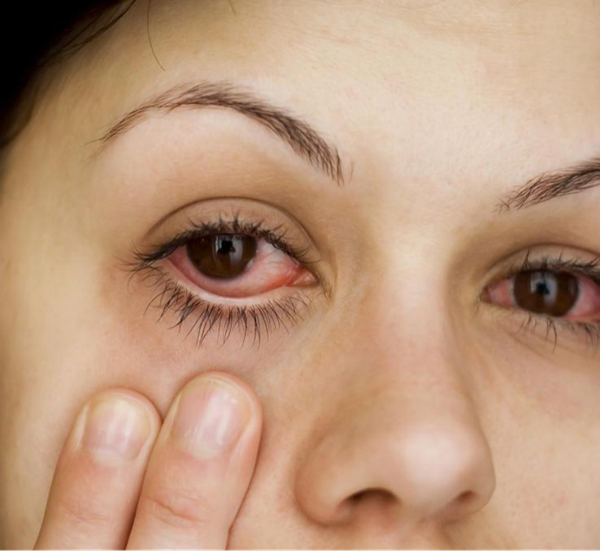 用眼過(guò)度嚴(yán)重的癥狀,用眼過(guò)度的危害,用眼過(guò)度測(cè)試,嚴(yán)重視疲勞有哪些癥狀表現(xiàn) 用眼過(guò)度嚴(yán)重的癥狀,用眼過(guò)度的危害,用眼過(guò)度測(cè)試,嚴(yán)重視疲勞有哪些癥狀表現(xiàn)