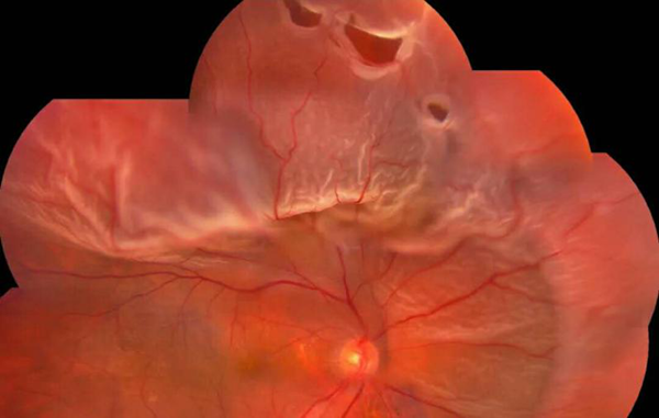 眼睛晶狀體脫落怎么辦 眼睛晶狀體脫落怎么辦