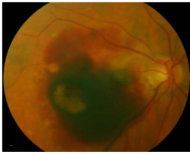 黃斑裂孔是什么眼病 黃斑裂孔是什么眼病