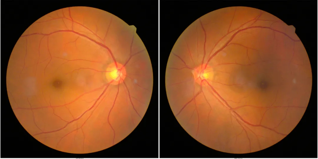 眼底有黃斑怎么辦,眼底病變還能治好嗎 眼底有黃斑怎么辦,眼底病變還能治好嗎