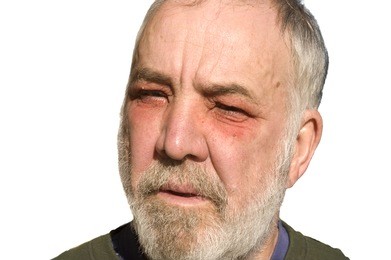 白內(nèi)障形成原因是什么,白內(nèi)障日常注意事項 白內(nèi)障形成原因是什么,白內(nèi)障日常注意事項